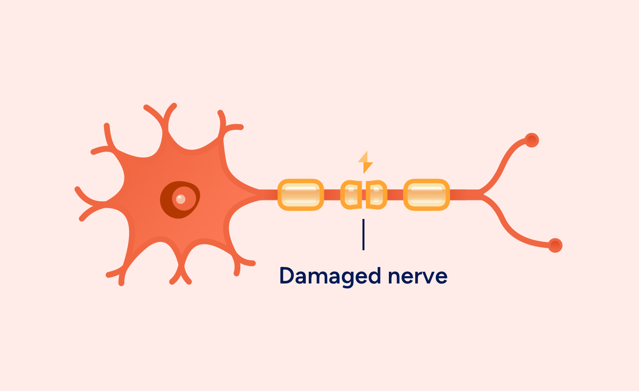 Nerve with damage myelin