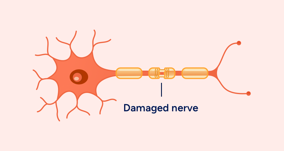 Nerve with damage myelin